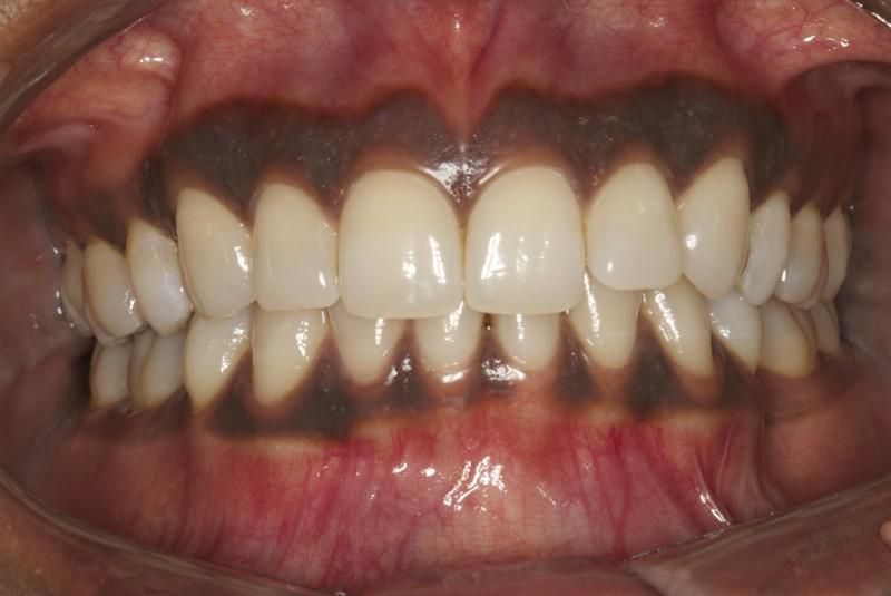 Dark gums(forum.dentalxp)