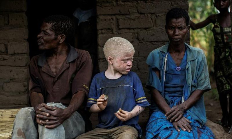 Malawi is seeing a surge in attacks on people with albinism -- many have been targeted for their body parts, for use in witchcraft