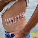 Kidney transplant