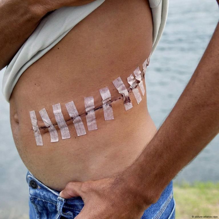Kidney transplant