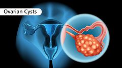 Causes of ovarian cysts(MaxCure Suyosha Hyderabad)