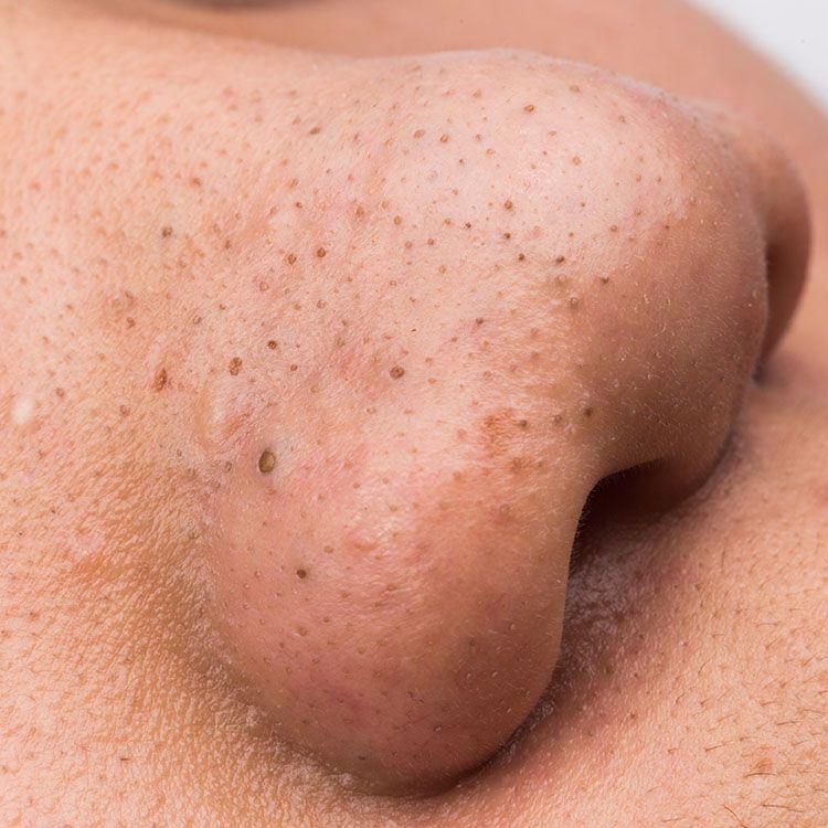 Blackheads