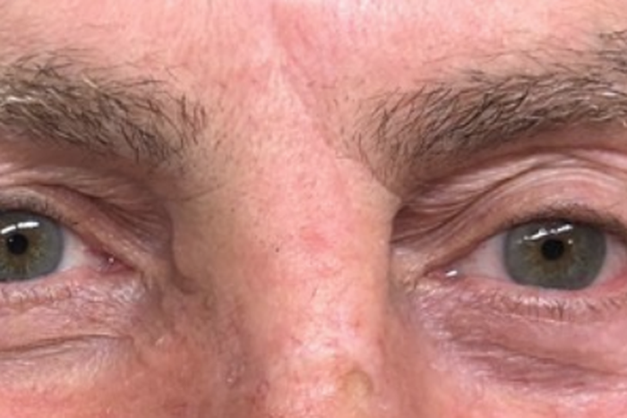 Dr. Pimple Popper Shares Skin Cancer Surgery Pics