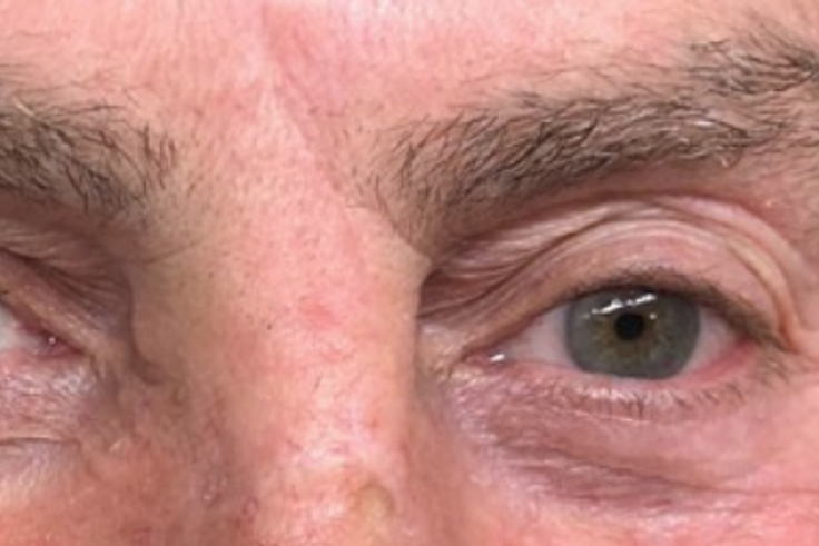 Dr. Pimple Popper Shares Skin Cancer Surgery Pics