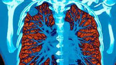 AI took a test to detect lung cancer, it got an A