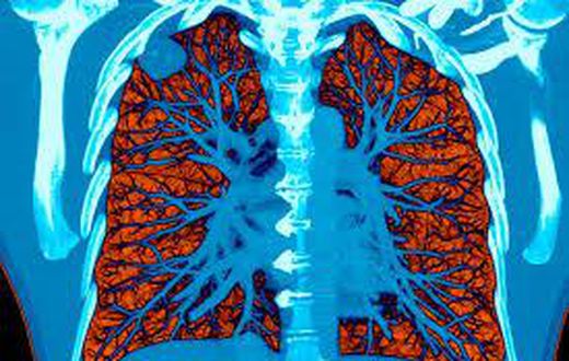 AI took a test to detect lung cancer, it got an A