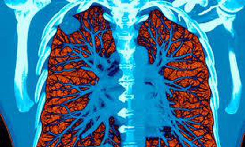 AI took a test to detect lung cancer, it got an A