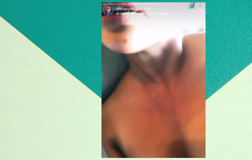 Why Chrissy Teigen Needs Dr. Pimple Popper's Help
