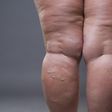 Habits that cause cellulite(inquisitr)
