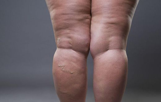 Habits that cause cellulite(inquisitr)