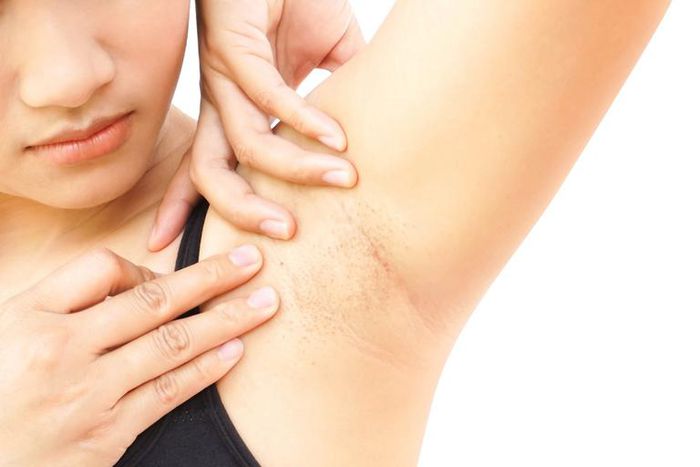 Dr. Pimple Popper Extracts Eruptive Cysts