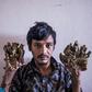 Abul Bajandar has had 25 operations since 2016 to remove growths from his hands and feet caused by a rare syndrome
