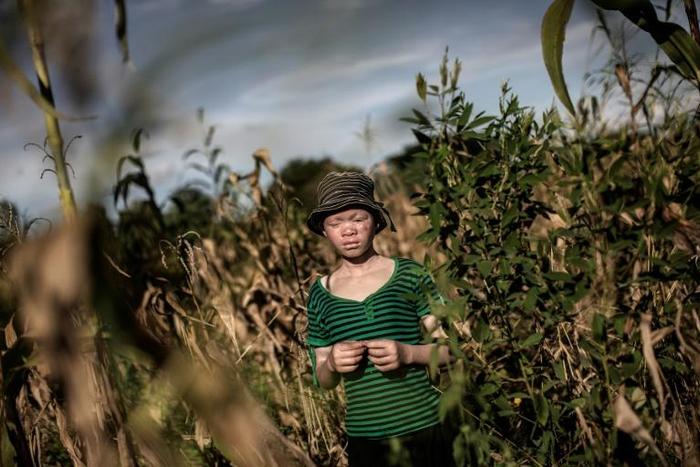 Albinos are often targeted in brutal attacks in Malawi - one of the world's poorest countries - because they have white skin due to a hereditary lack of pigmentation