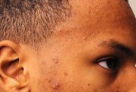 Acne on the other hand implies frequent breakouts of pus filled pimples.