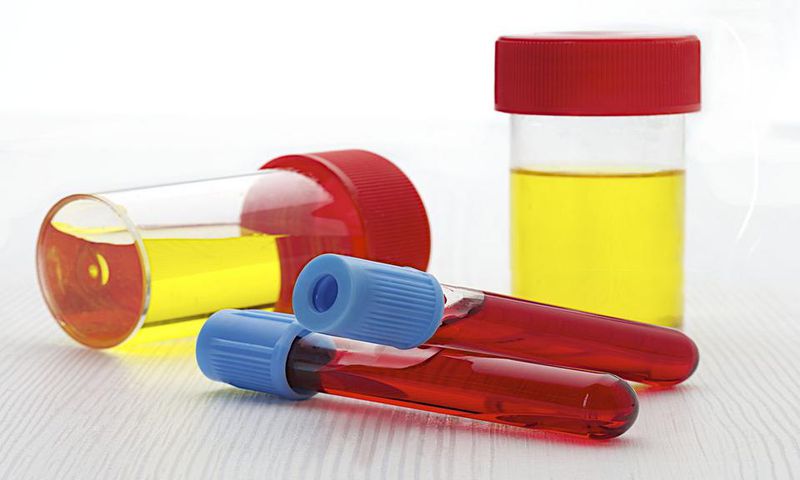 Causes of blood in urine(healthhearty)