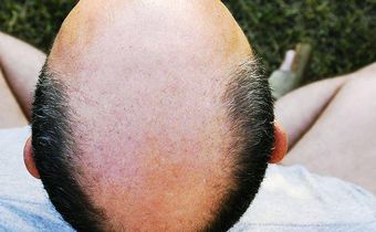 7 Ways to Slow Down Hair Loss