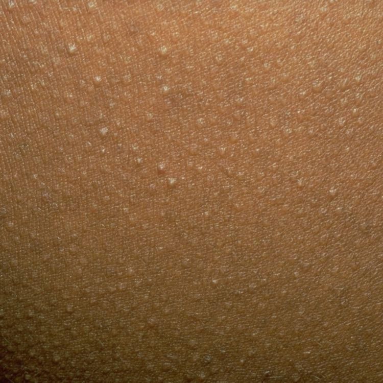 12 Bumps On Your Skin That You Should NEVER Pop