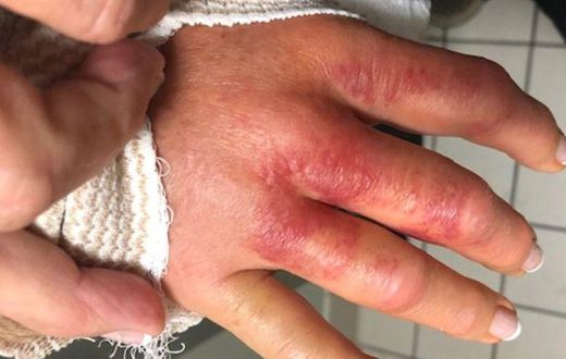 Woman Contracts Flesh-Eating Bacteria At Salon