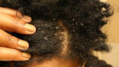 Dandruff (howkenya)
