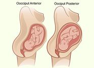 OP position causes vaginal tears(MomJunction)