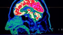A new study honed in on the brain circuitry responsible for upgrading or downgrading pain signals, likening the mechanism to how a home thermostat controls room temperature