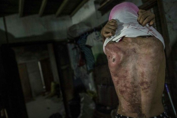 Former child servant, 14-year old Khin Khin Tun, shows the deep scars on her back at Mawlamyine, some 300 kms southeast of Yangon, on February 13, 2017
