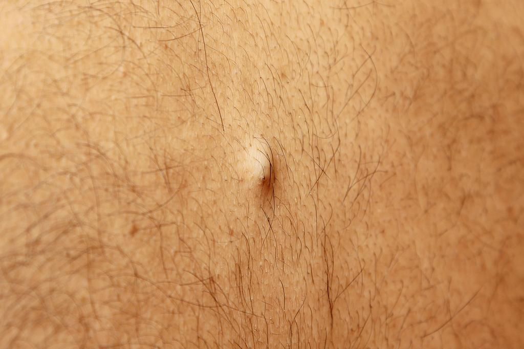 sebaceous cyst on the back of the male