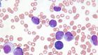 Would You Be Able To Spot These 7 Symptoms Of Leukemia?