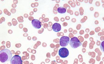 Would You Be Able To Spot These 7 Symptoms Of Leukemia?