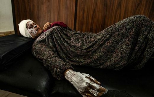 Syrian patient Fatima al-Issa who was hit by shrapnel during Turkish bombardment of Ras al-Ain, rests after receiving treatment at a hospital in the town of Tal Tamr in the countryside of Syria's northeastern Hasakeh province, on October 11, 2019.Ankar...