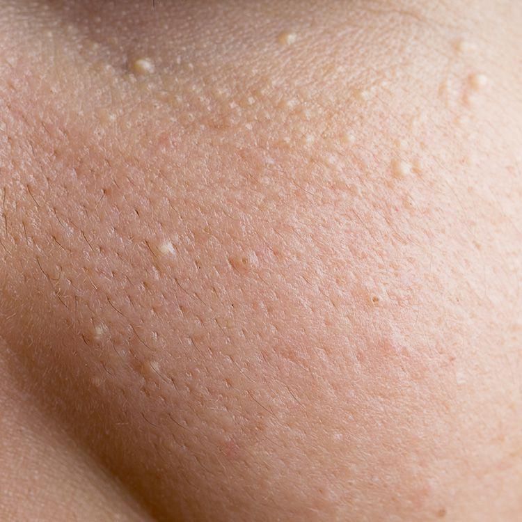 12 Bumps On Your Skin That You Should NEVER Pop