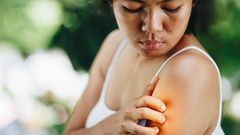 6 Types Of Bug Bites You Never Want To Ignore