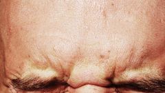 Dr. Pimple Popper Clears Forehead Of Blackheads