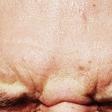 Dr. Pimple Popper Clears Forehead Of Blackheads