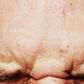 Dr. Pimple Popper Clears Forehead Of Blackheads