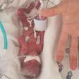 Iowa Mom Gives Birth 4 Months Early