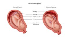 Placental Abruption(New Mums Hub)