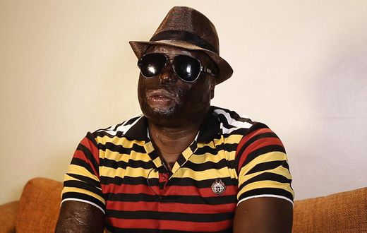 Dan Matakaya during interview. My wife poured acid on me and electrocuted me, I'm blind for life