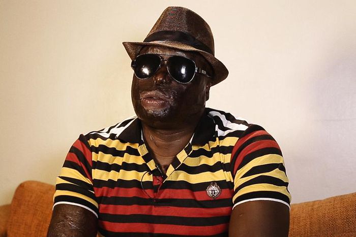 Dan Matakaya during interview. My wife poured acid on me and electrocuted me, I'm blind for life