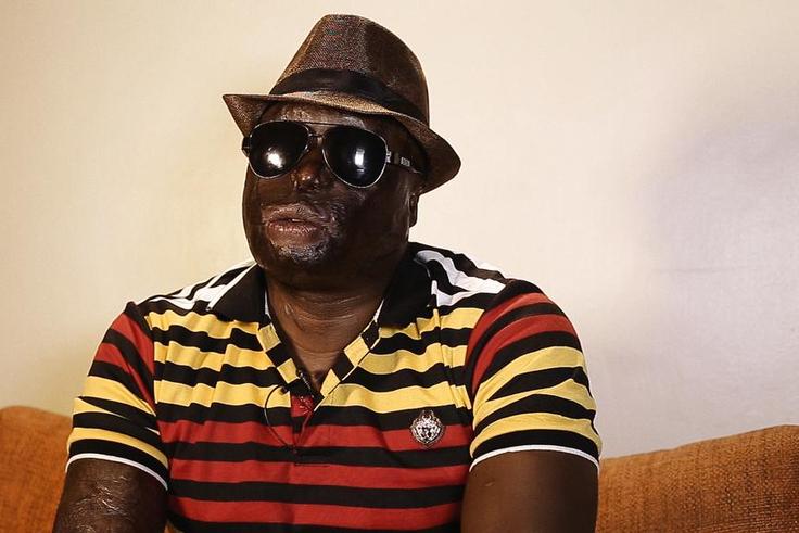Dan Matakaya during interview. My wife poured acid on me and electrocuted me, I'm blind for life
