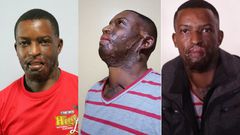 I went on Facebook Live to commit Suicide- Acid attack survivor Kelvin Kairo tells it all