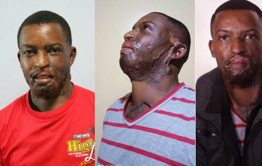 I went on Facebook Live to commit Suicide- Acid attack survivor Kelvin Kairo tells it all