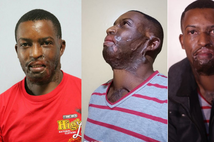 I went on Facebook Live to commit Suicide- Acid attack survivor Kelvin Kairo tells it all
