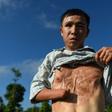 Vietnamese landmine victim Nguyen The Nghia in January 2020 shows his wounds caused by a munitions explosion when he was younger in Quang Tri province