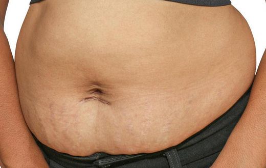Post baby belly (BabyCentre)