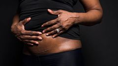 C-section scar (HuffPost)
