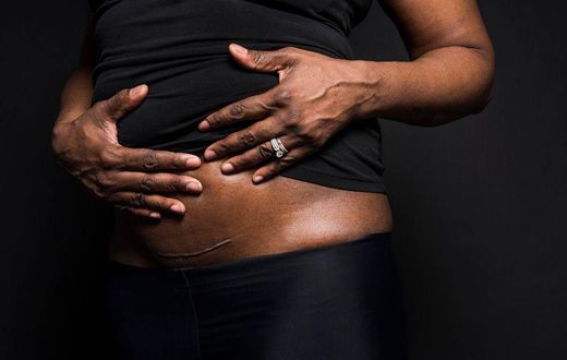 C-section scar (HuffPost)