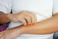 Soothe a Bad Sunburn With These 6 Pain Relief Tips