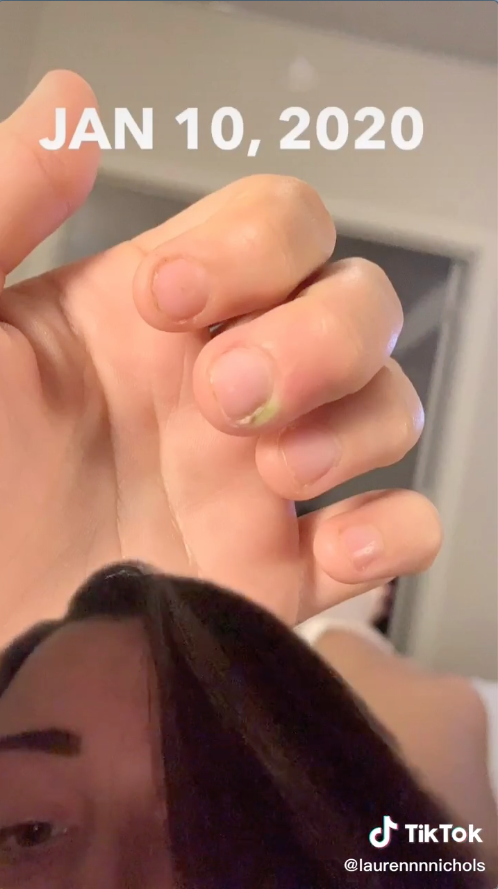 Teen Warns Against Nail Biting After Infection