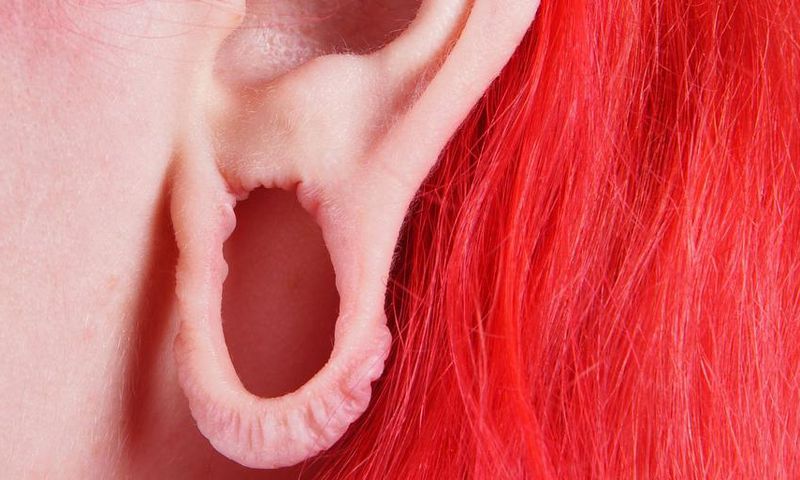 Dr. Pimple Popper Repairs a Stretched Earlobe